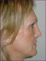 After facial feminisation